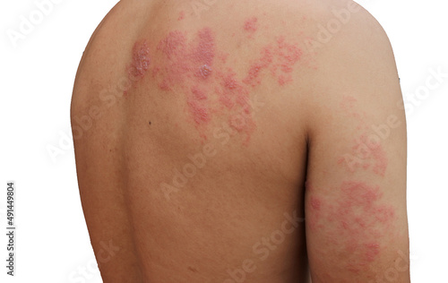 Skin diseases caused by viral infections,shingles
