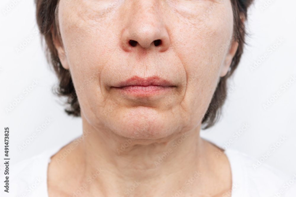The lower part of elderly woman's face and neck with signs of skin aging isolated on a white background. Age-related changes, flabby sagging facial skin, wrinkles and creases. Cosmetology and beauty The lower part of elderly woman's face and neck with signs of skin aging isolated on a white background. Age-related changes, flabby sagging facial skin, wrinkles and creases. Cosmetology and beauty