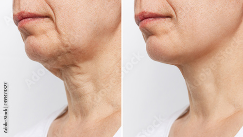 Fotografia Lower part of the face and neck of elderly woman with signs of skin aging before and after facelift, plastic surgery on white background