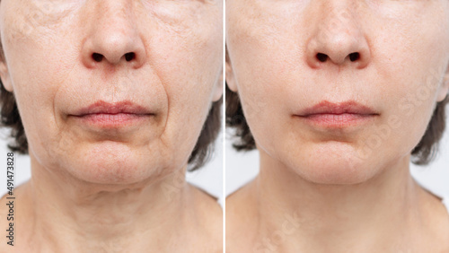 Lower part of face and neck of elderly woman with signs of skin aging before after facelift, plastic surgery on white background. Age-related changes, flabby sagging skin, wrinkles, creases, puffiness photo