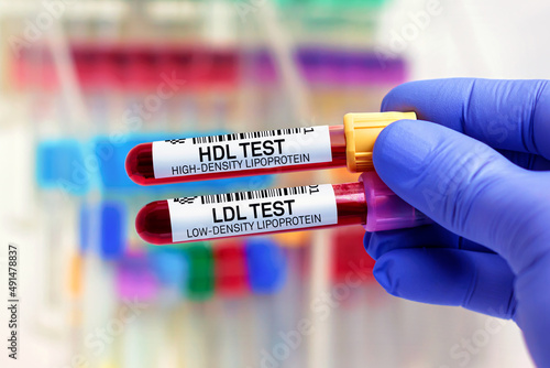 doctor with Blood tubes for HDL High Density Lipoprotein and LDL Low Density Lipoprotein test. Blood samples of patient for High Density Lipoprotein HDL and  Low Density Lipoprotein LDL test in lab photo