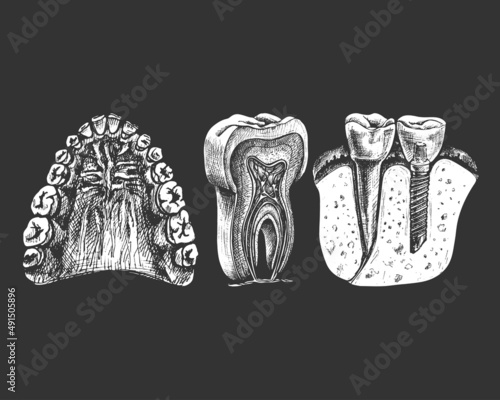 114_ jaw, teeth, gums, palate_dental implant_tooth structure, graphics_jaw, teeth, gums, sky, graphics, isolated vector drawing, anatomical, detailed sketch, set, tooth, dental implant, colored,