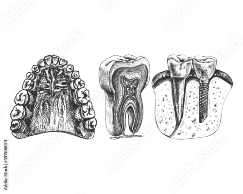 114_ jaw, teeth, gums, palate_dental implant_tooth structure, graphics_jaw, teeth, gums, sky, graphics, isolated vector drawing, anatomical, detailed sketch, set, tooth, dental implant, colored,