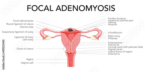 Focal Adenomyosis with inscriptions, Human anatomy Female reproductive Sick system organs. Structure of uterus, cervix, ovary, fallopian tube in Latin text. Frontal view in a cut Vector illustration