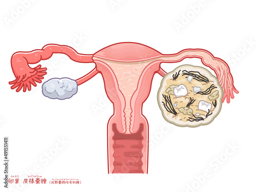 卵巣嚢腫・皮様嚢腫・奇形腫のイラスト