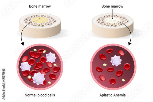 Aplastic anemia. The difference between normal blood and aplastic anemia. Red blood cells, White blood cells and platelets.