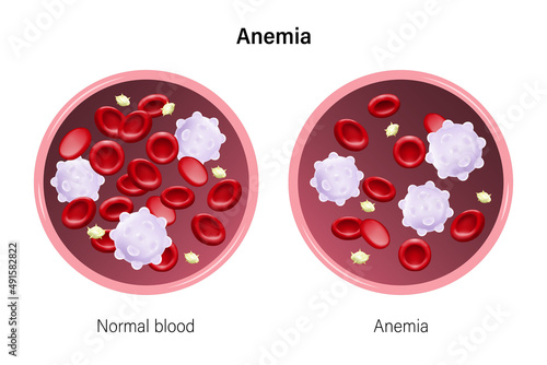 Anemia. The difference of Anemia amount of red blood cell and normal. Red blood cells, White blood cells and platelets.