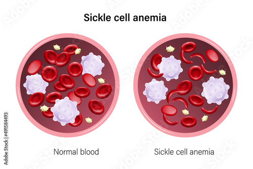 Sickle cell aemia. The difference of blood sickle cell aemia and normal blood. Red blood cells, White blood cells and platelets.