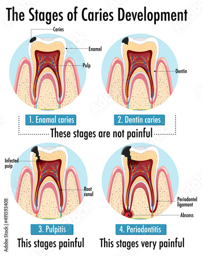 Infographic of human in the stages of caries development