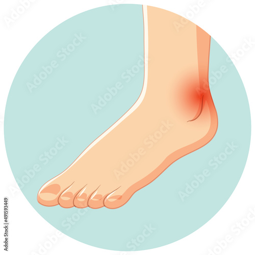 Achilles tendo rupture in circle template