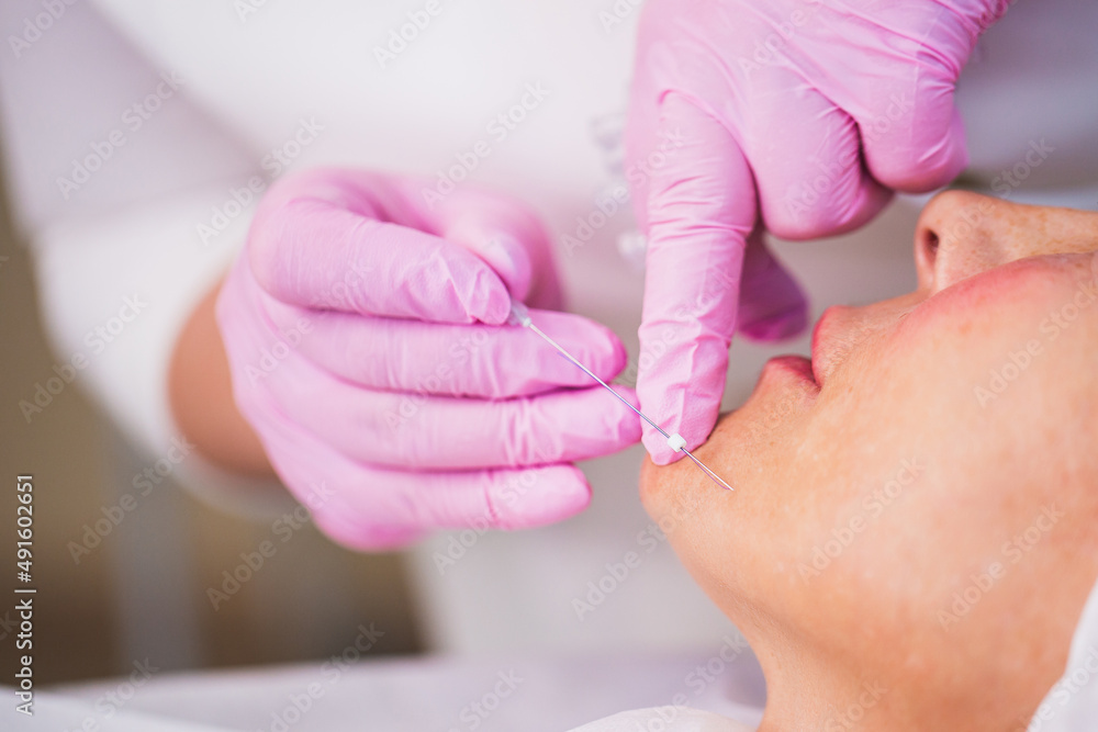 Thread lifting of the face is a minimally invasive mesotherapeutic procedure - the doctor makes a puncture of the skin and introduces synthetic or metal threads - forms and strengthens the skin Thread lifting of the face is a minimally invasive mesotherapeutic procedure - the doctor makes a puncture of the skin and introduces synthetic or metal threads - forms and strengthens the skin