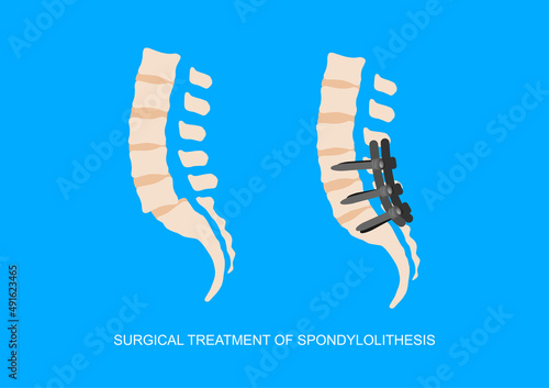 Surgical treatment of slipped lumbrosacral vertebra