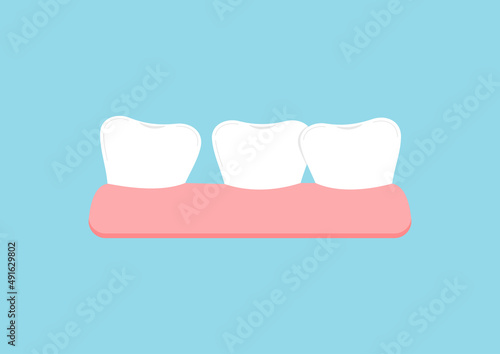 Crooked teeth in gym icon isolated. Dental crowding tooth for orthodontic bracket correction treatment. Vector flat design cartoon style dentistry misaligned illustration.