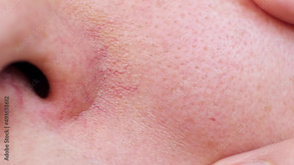 pores on the face. oily skin of the face. Part of a woman's face close-up. Irritation, allergies, problem skin. Skin texture with enlarged pores. pores on the face. oily skin of the face. Part of a woman's face close-up. Irritation, allergies, problem skin. Skin texture with enlarged pores.