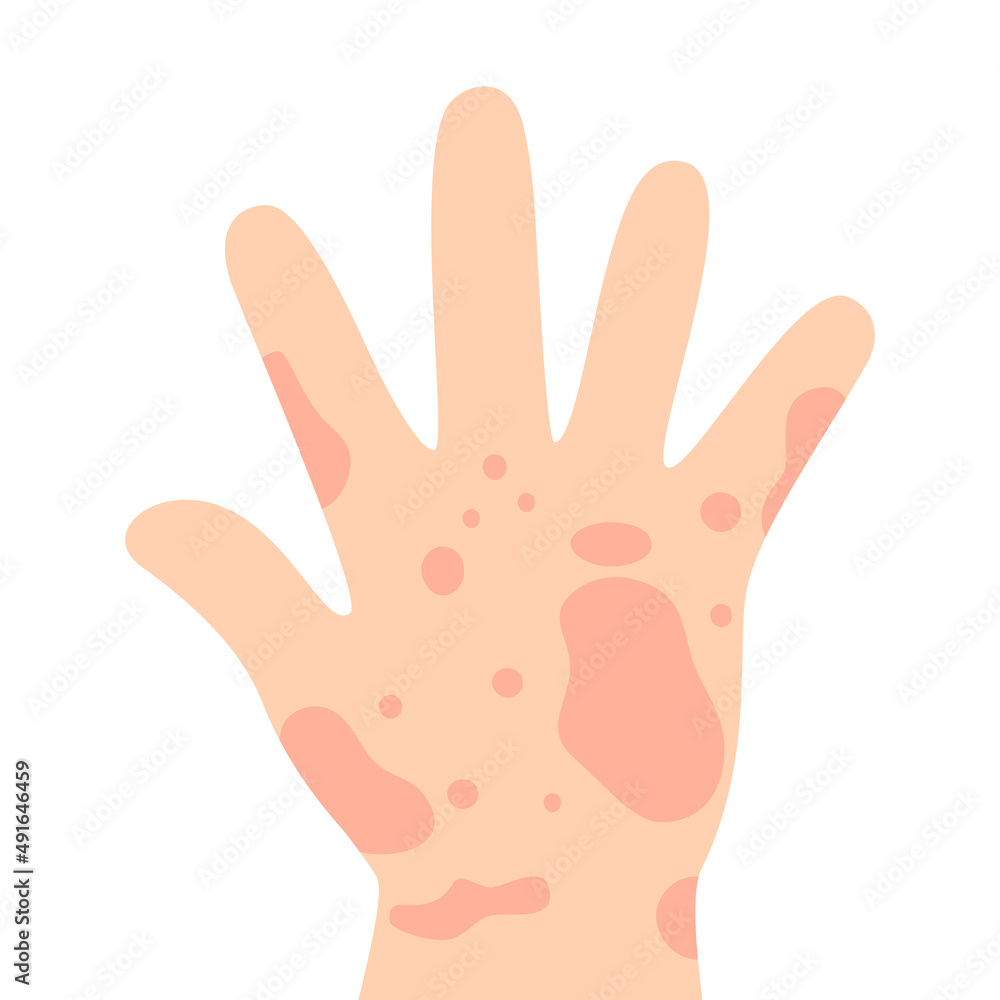 Red rash on hand in flat design on white background. Itching and irritation symptom. Skin allergy. Red rash on hand in flat design on white background. Itching and irritation symptom. Skin allergy.