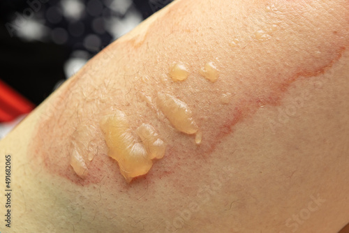 Close up leg with terrible burn. Injury after hot water on skin. Accident at home, scalds wound. Careless concept. Need emergency help.