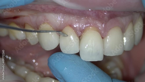 macro shooting of the fitting of ceramic veneers on the central teeth