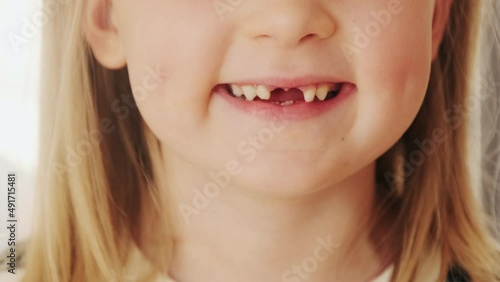 Close-up mouth child has lost two milk teeth. Replacement of permanent changing teeth, toothless smile and hole in the gum. Children is dentistry concept. photo