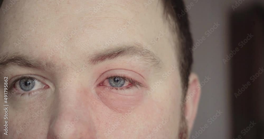 Man has pink eye, eye infection with swollen eyelids and irritated eye Man has pink eye, eye infection with swollen eyelids and irritated eye