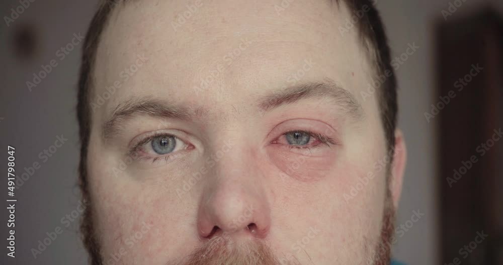Man has pink eye, eye infection with swollen eyelids and irritated eye Man has pink eye, eye infection with swollen eyelids and irritated eye