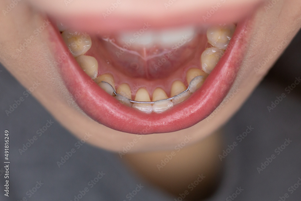 Closeup of a broken permanent bonded retainer.