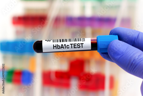 Blood sample for study of HbA1c or Hemoglobin A1c for detection of diabetes. doctor holding Blood tube for HbA1c analysis and identification of diabetic patient photo