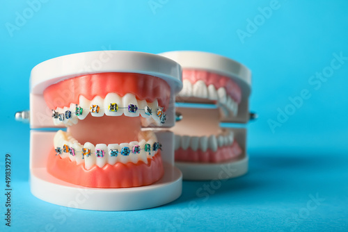 Model of jaws with braces on blue background
