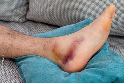Tableau sur toile Ankle injury with dislocation and sprains
