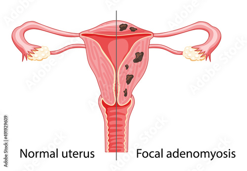 Focal Adenomyosis Human anatomy Female reproductive Sick system vs versus normal. Compared educational healthy and abnormal anatomy organs uterus icon flat cartoon vector illustration isolated