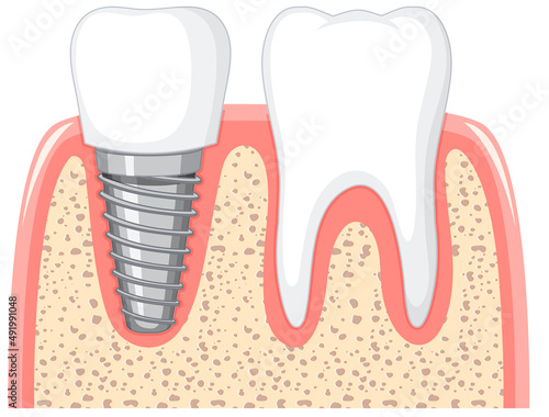 Heathy tooth and dental implant in gum on white background