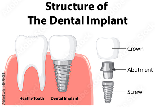 Infographic of human in structure of the dental implant