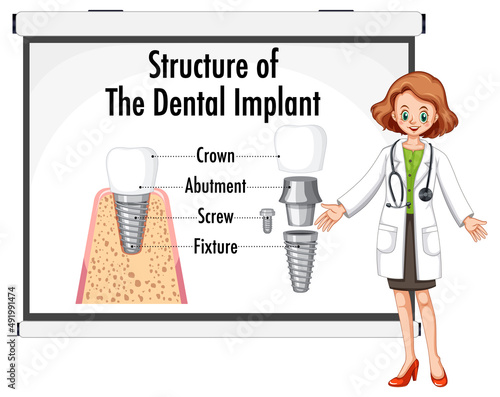 Infographic of human in structure of the dental implant