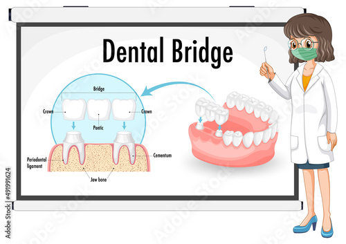 Infographic of human in dental bridge on white background