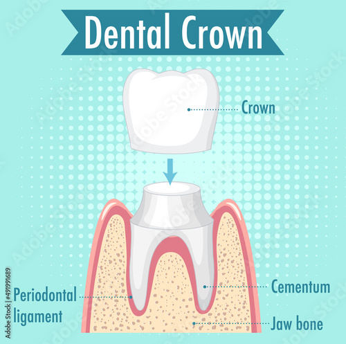 Infographic of human in dental crown