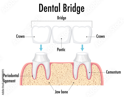 Infographic of human in dental bridge on white background