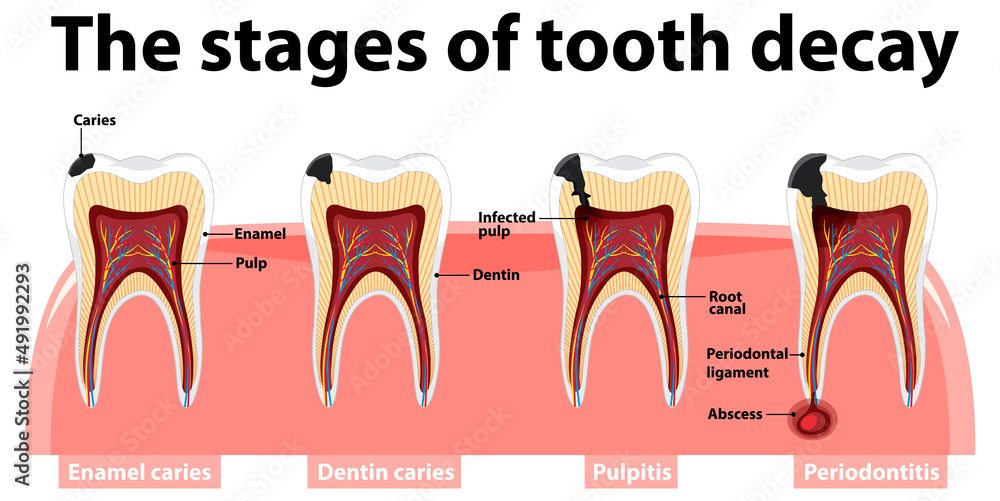 Infographic of human in the stages of tooth decay Stock Vector Adobe