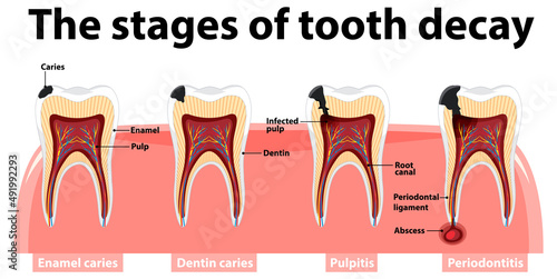 Infographic of human in the stages of tooth decay