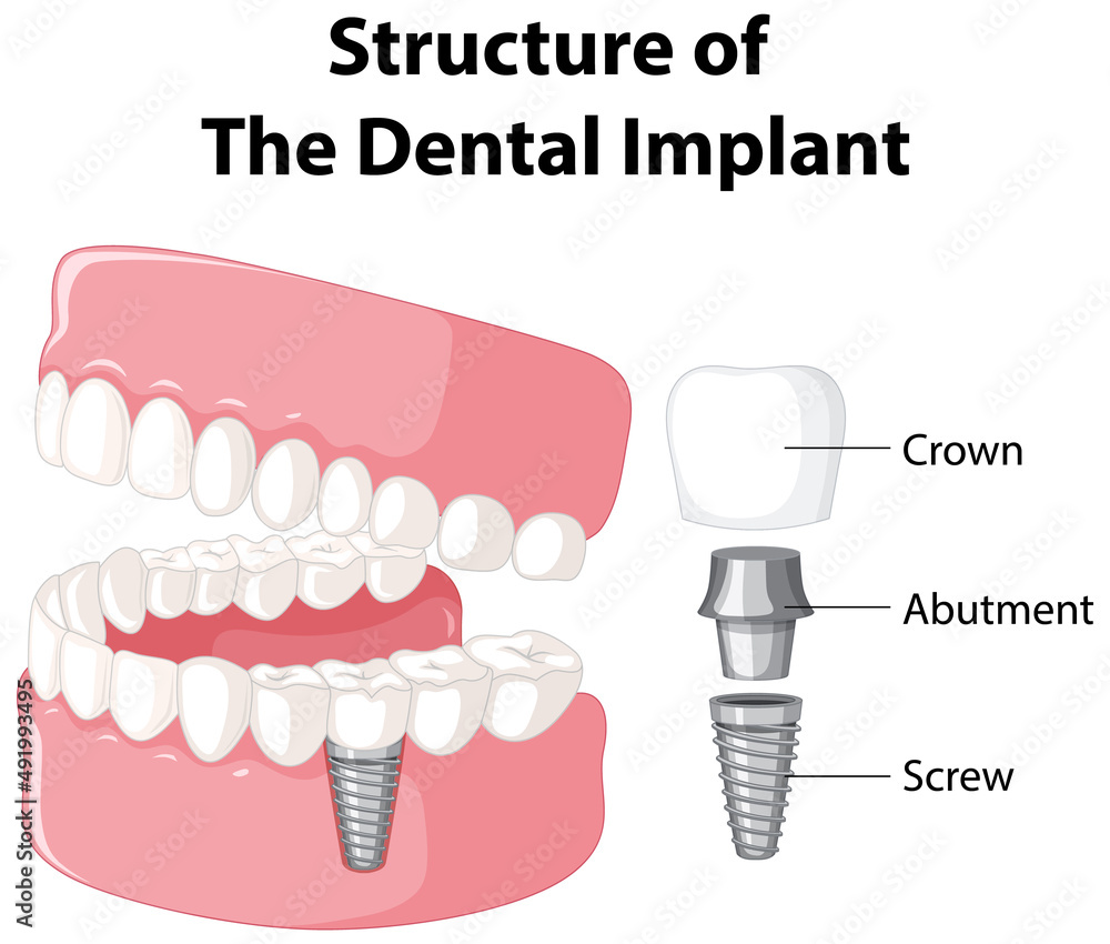 Infographic of human in structure of the dental implant Stock Vector
