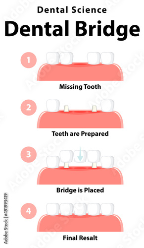 Infographic of human in dental bridge