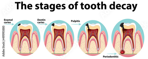 Infographic of human in the stages of tooth decay