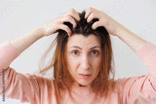 Unhappy young woman scratches head with hands caused by dandruff, pediculosis and seborrhea, feels discomfort, The concept of hair problems. looking at camera photo