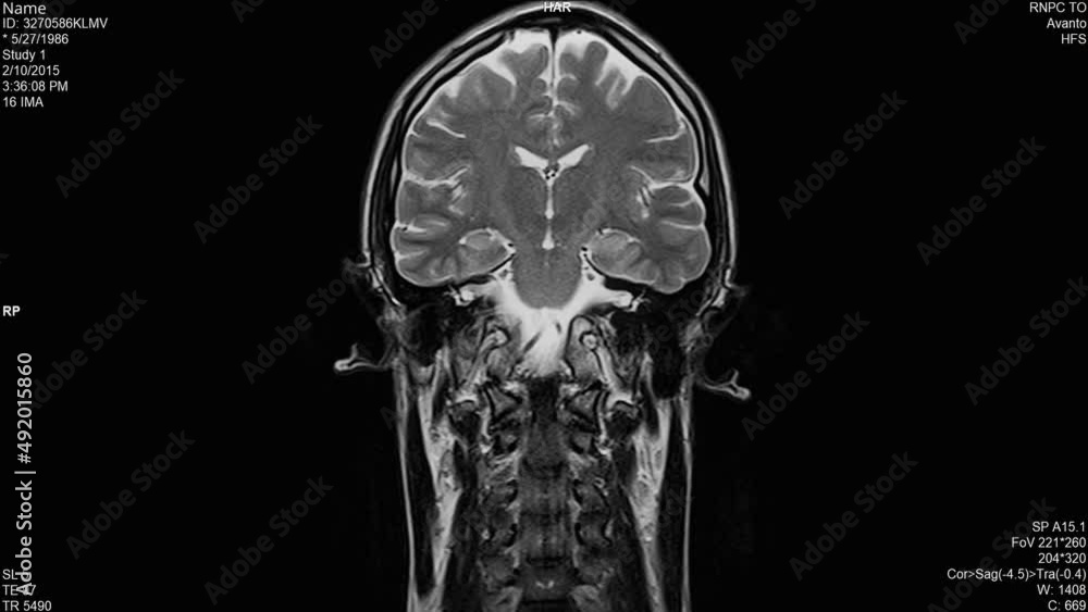 Magnetic resonance images of the brain (MRI brain), coronal plane axial view sequence in cine mode. T2-weighted MRI (T2-TSE-COR-P2) showing normal anatomy