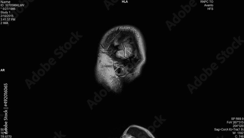 Magnetic resonance images of the brain (MRI brain), sagittal plane axial view sequence in cine mode. T2-weighted MRI (T2-TSE-TRA-P2) showing normal anatomy photo