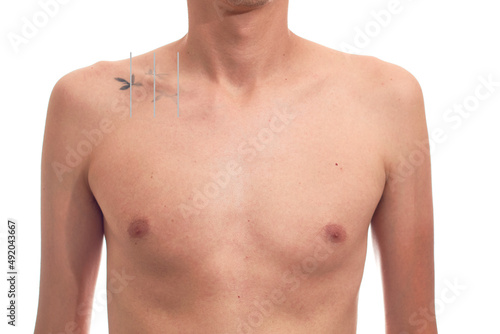 Laser tattoo removal procedure for men.