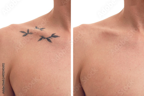 Before and after laser tattoo removal on a man. photo