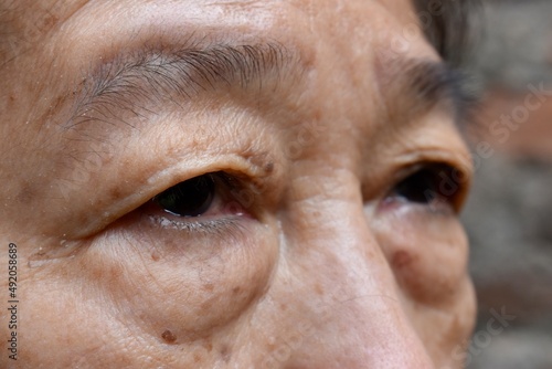 Prominent fat bag under eye of Asian elder woman. photo
