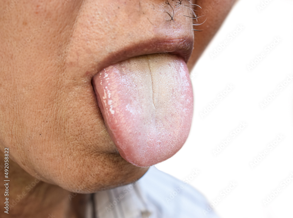 Coated tongue or white tongue. Loss of taste called ageusia. Coated tongue or white tongue. Loss of taste called ageusia.