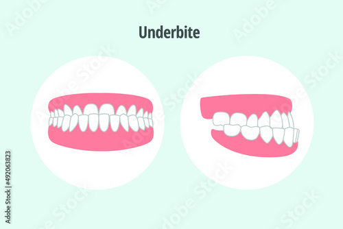 icon dental problem. vectorial illustration Underbite photo