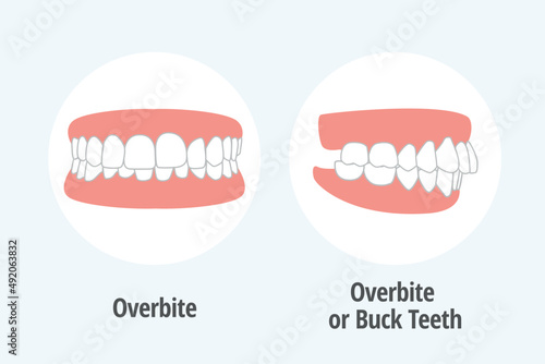 icon dental problem. vectorial illustration Overbite photo