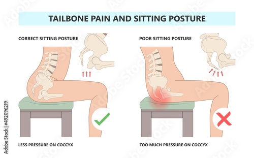 Tail bone pain floor hip spine sitting down back leg fall slip broken poor chair lower trauma tumor symptom joint surgery coccalgia good work from home computer ergonomic seating sacroiliitis 